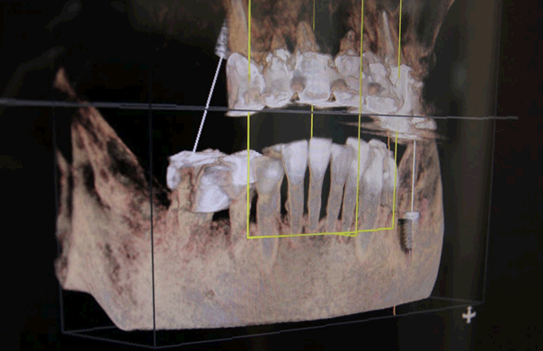 CTシミュレーション